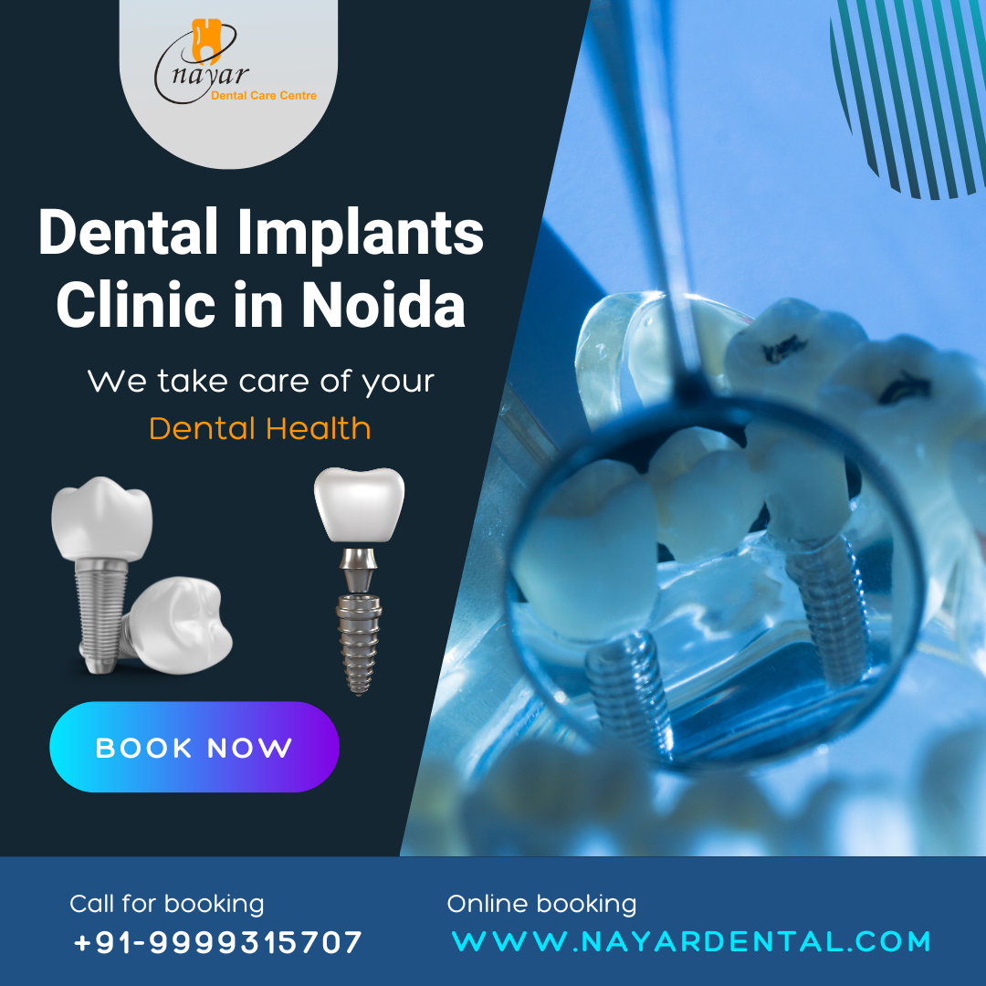 Read more about the article Dental Implants Clinic in Noida